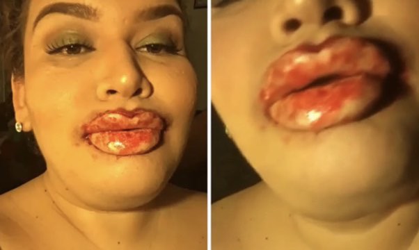 Fake botox lips